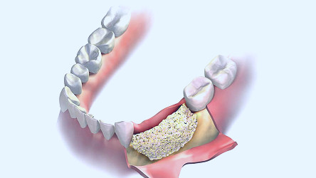 Benefits Of Dental Bone Grafting | Omega Dental Houston TX